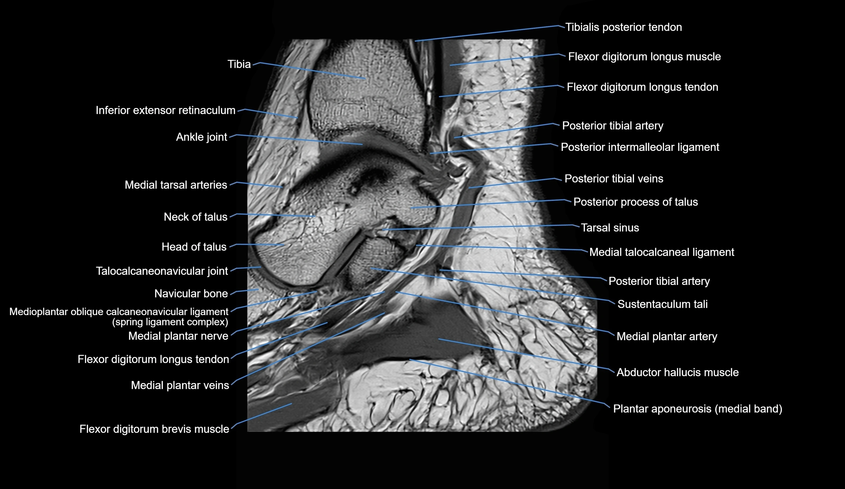 MRI Ankle sagittal cross sectional anatomy 3T  radiology  image-img-00001-00010.webp